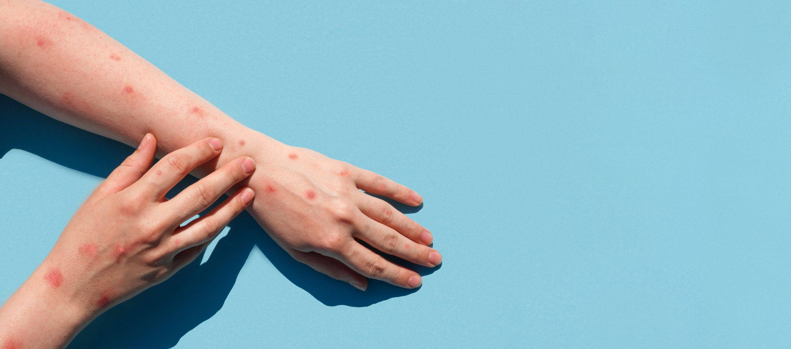 AP-HP : réduire le risque de mpox